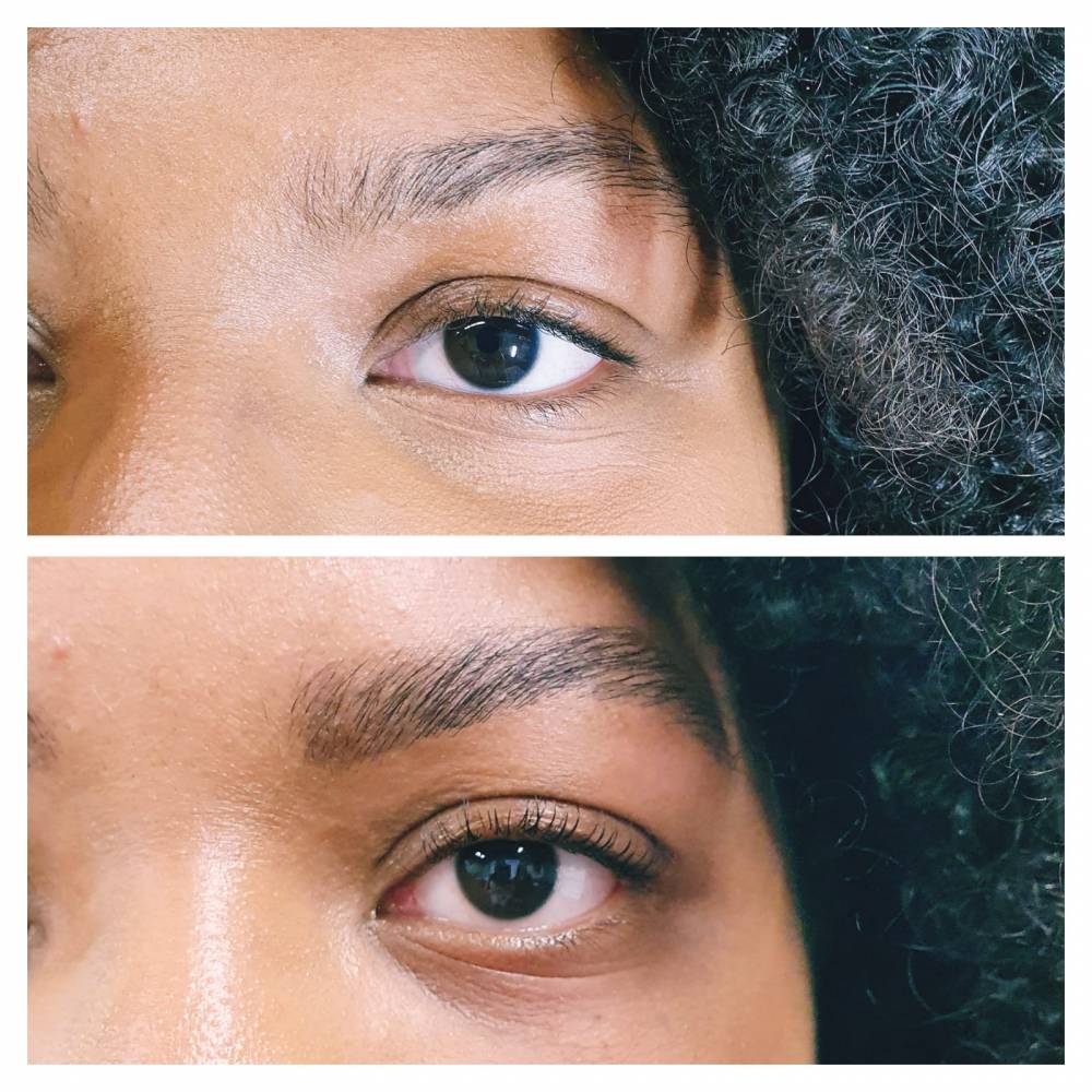 brow-lift-montpellier.jpg